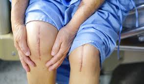 Best Knee Replacement Surgeon