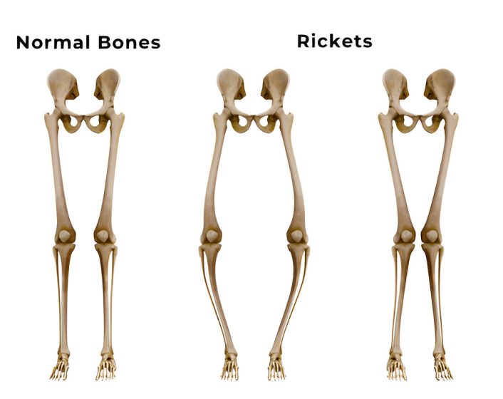 Bone Deformities Treatment