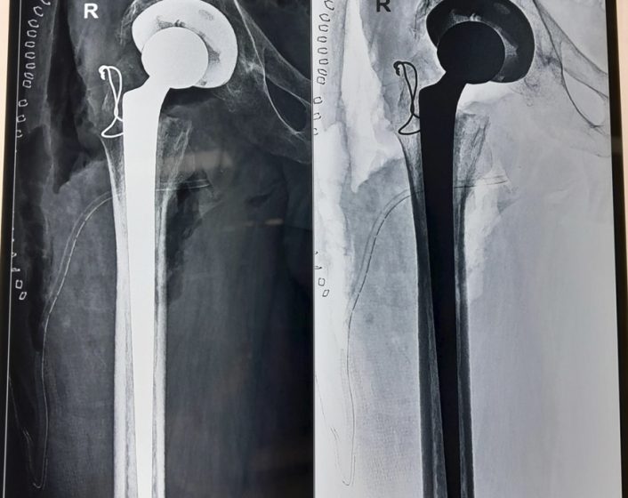 Hip Replacement1