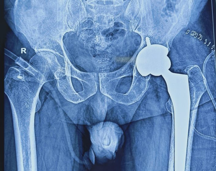 Hip Replacement2