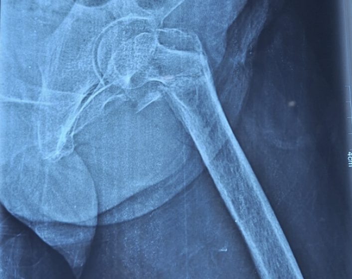 Hip Replacement3