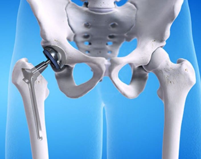 Hip replacement