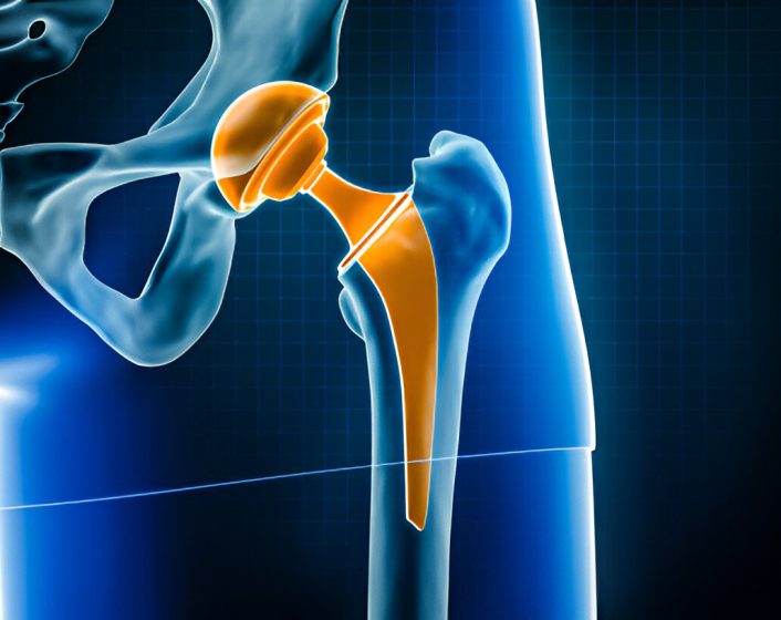 Joint Replacement Treatments