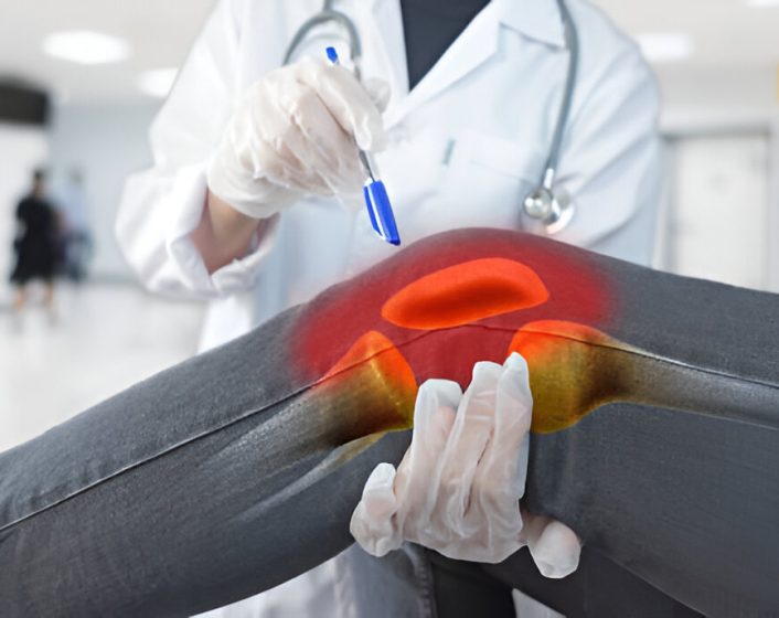 LCL Injury