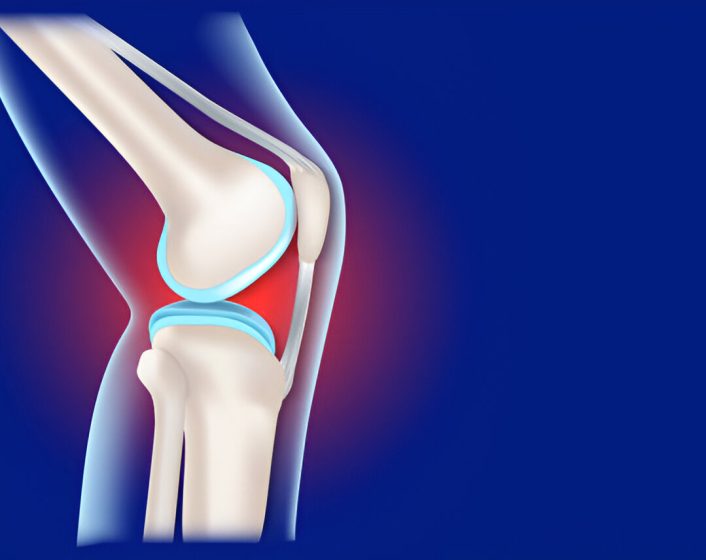 MCL Injury