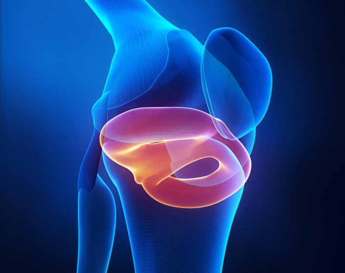 Meniscal Injury