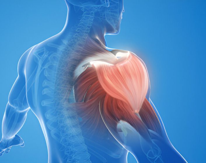 Shoulder Dislocation