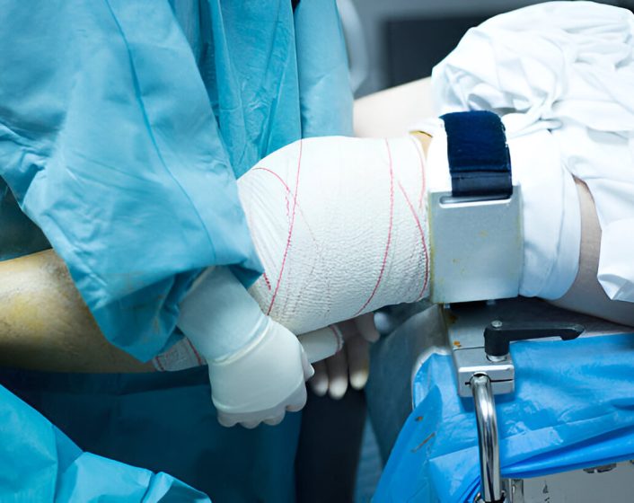 medial collateral ligamenttreatment